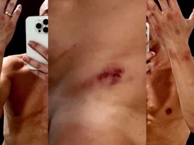 含泪讲述在台湾被两次迷奸，香港男星王喜发伤痕照片